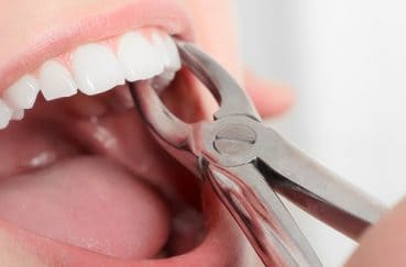 歯の治療で「抜歯」が必要になるのはどんな場合？