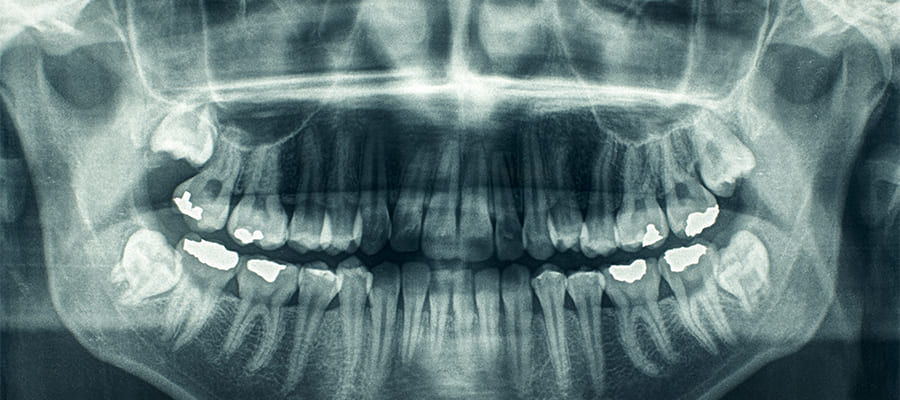 歯科でのレントゲン撮影って安全なの？