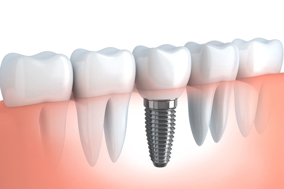 江東区東雲、豊洲の歯医者のキャナルコート歯科クリニック　インプラント治療とは？