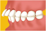 江東区東雲、豊洲の歯医者のキャナルコート歯科クリニック　矯正歯科　上顎前突（出っ歯）