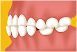 江東区東雲、豊洲の歯医者のキャナルコート歯科クリニック　矯正歯科　下顎前突（受け口）