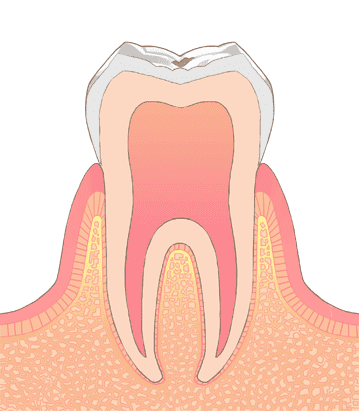 江東区東雲、豊洲の歯医者のキャナルコート歯科クリニック　C0（脱灰）