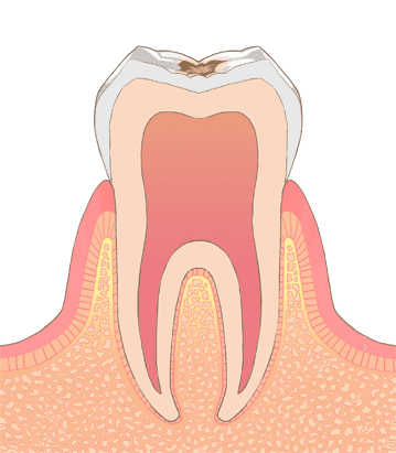 江東区東雲、豊洲の歯医者のキャナルコート歯科クリニック　C1（エナメル質の虫歯）