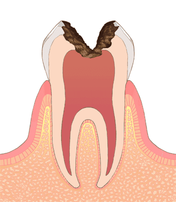江東区東雲、豊洲の歯医者のキャナルコート歯科クリニック　C3（神経まで進行した虫歯）