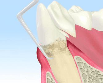 江東区東雲、豊洲の歯医者のキャナルコート歯科クリニック　歯周病治療プラークコントロール