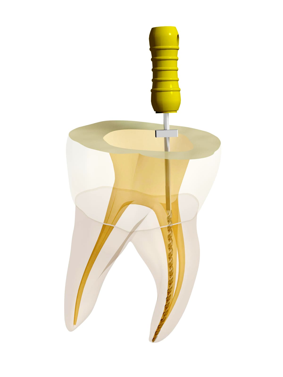 江東区東雲、豊洲の歯医者のキャナルコート歯科クリニック　神経まで達した虫歯はどうやって治療するの？