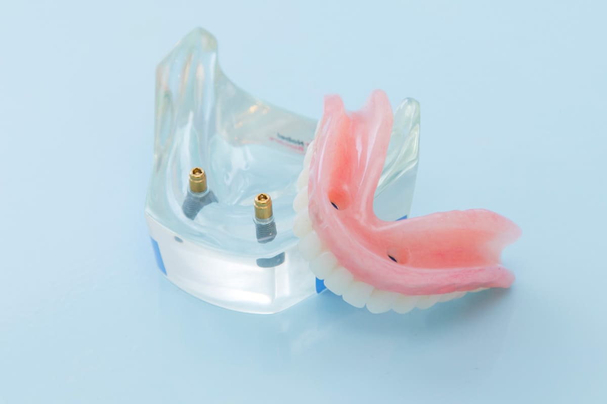 総入れ歯を安定させるロケーター（ロケーター・アバットメント）