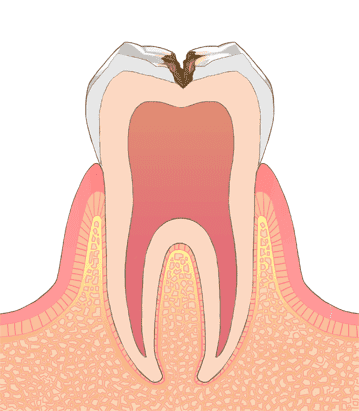江東区東雲、豊洲の歯医者のキャナルコート歯科クリニック　C2（象牙質の虫歯）