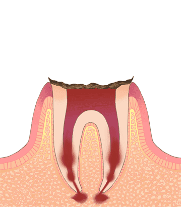 江東区東雲、豊洲の歯医者のキャナルコート歯科クリニック　C4（歯の根まで進行した虫歯）