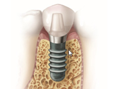 インプラント治療の流れ Step 5. 人工歯の取り付け
